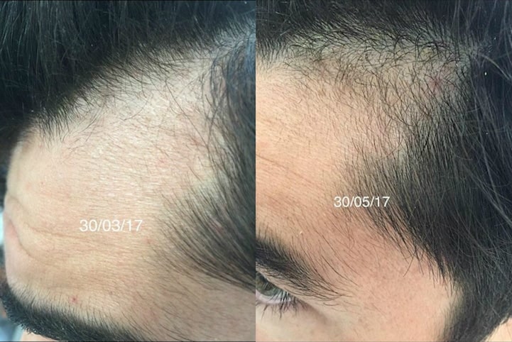 Brotzu Lotion For Hair Loss? Maybe, Maybe Not. (See Photos)