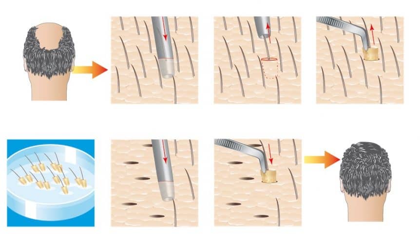 Do Hair Transplants Debunk The Scalp Tension-Hair Loss Hypothesis?