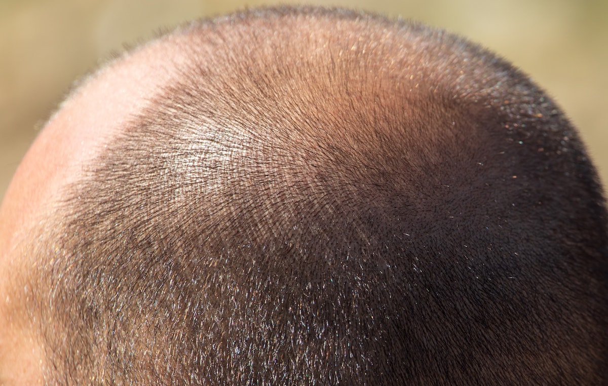 Androgenic Alopecia (AGA): What Is It, What Causes It, And What Don’t We Know?