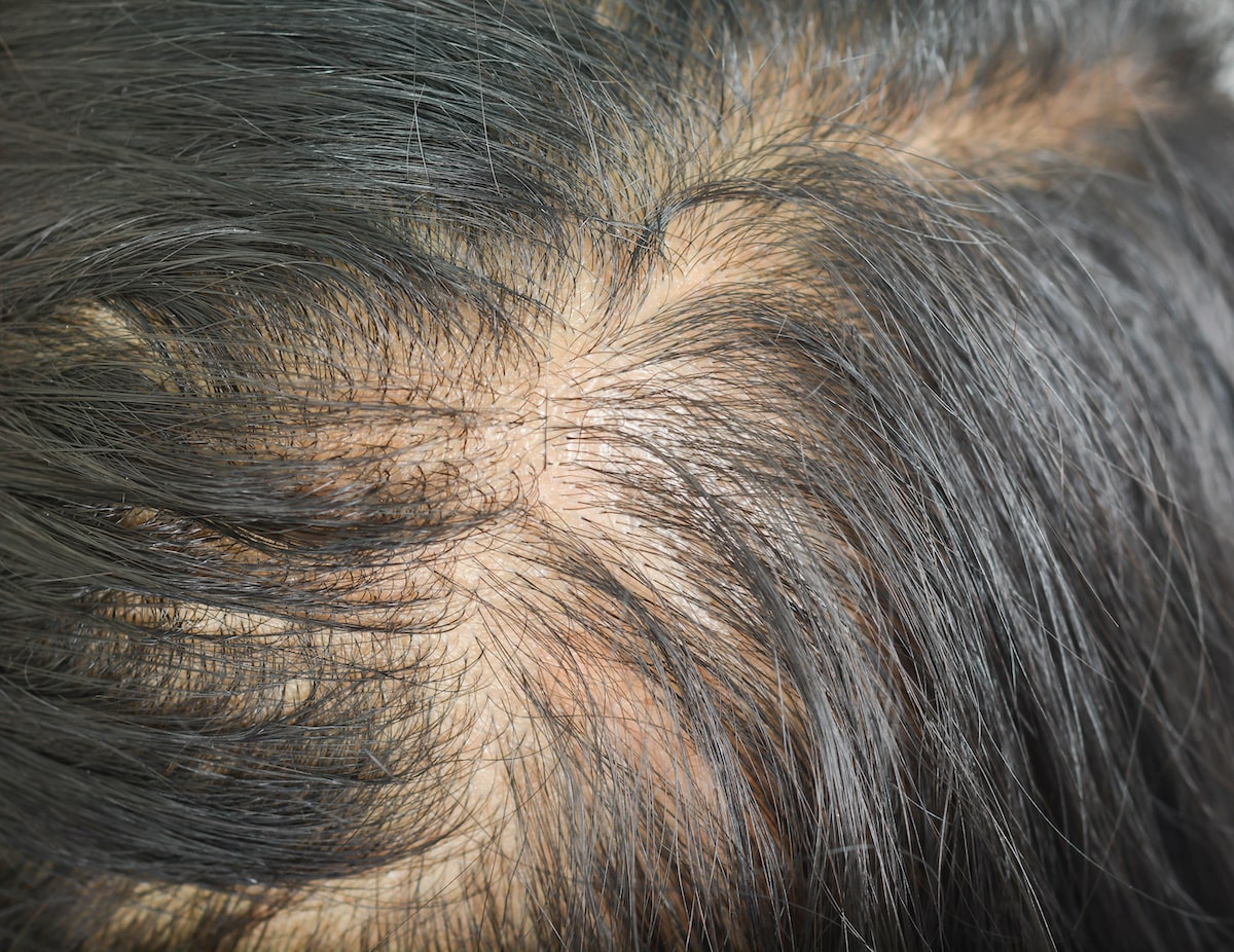 Diffuse Thinning: Causes, Implications, And Steps For Regrowth (See Photos)