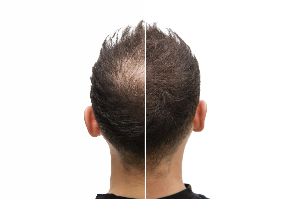 Scalp Micropigmentation: Mistakes To Avoid