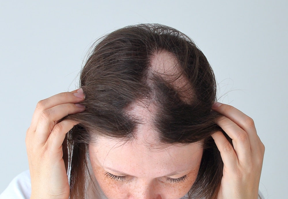 Alopecia Areata: Causes, Treatments, & Why It’s Reversible | 2020 Review