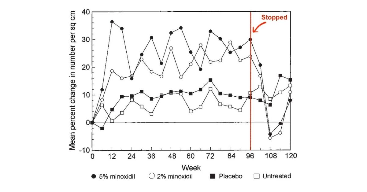 How Long After Stopping Minoxidil Before We Lose Our Hair Gains?