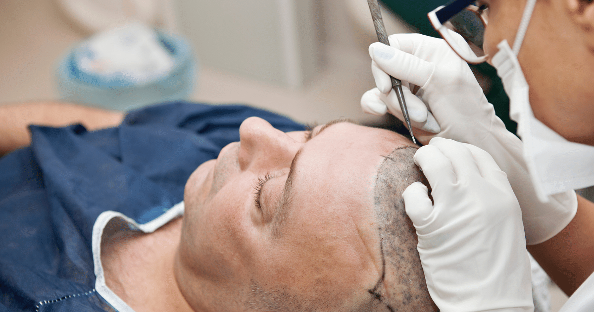 How Long Does a Hair Transplant Last?