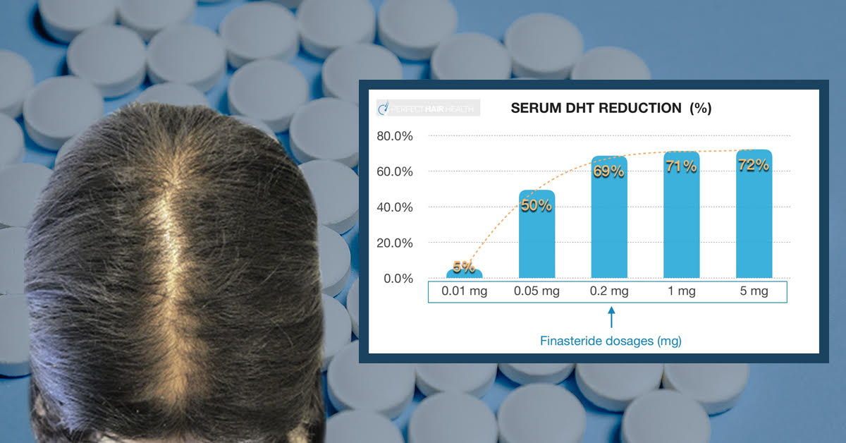 Finasteride For Women: What’s The Perfect Dose?