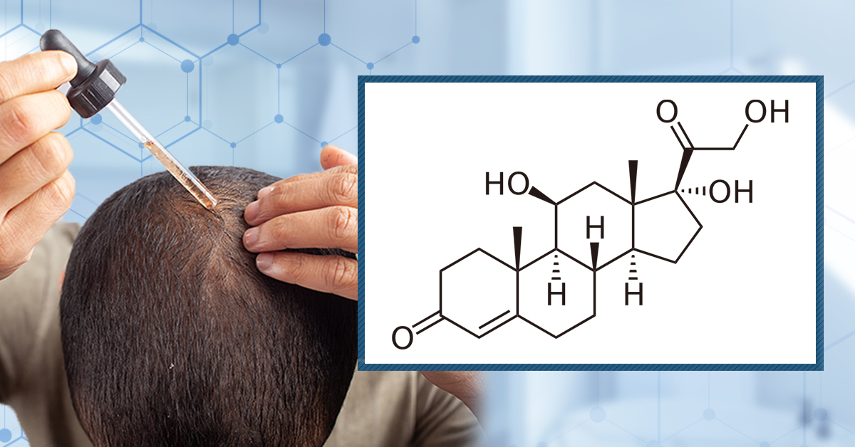 Are Low-Potency Corticosteroids Safe for Use as Hair Loss Treatments?