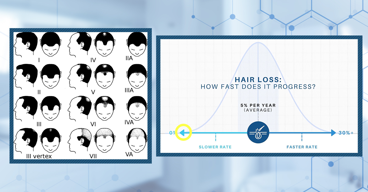 How To Identify How Fast You’re Losing Hair & Why This Matters