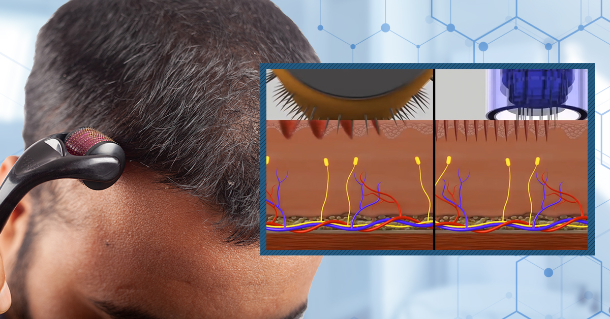 Am I Supposed to Bleed When Microneedling? A Scientific Analysis