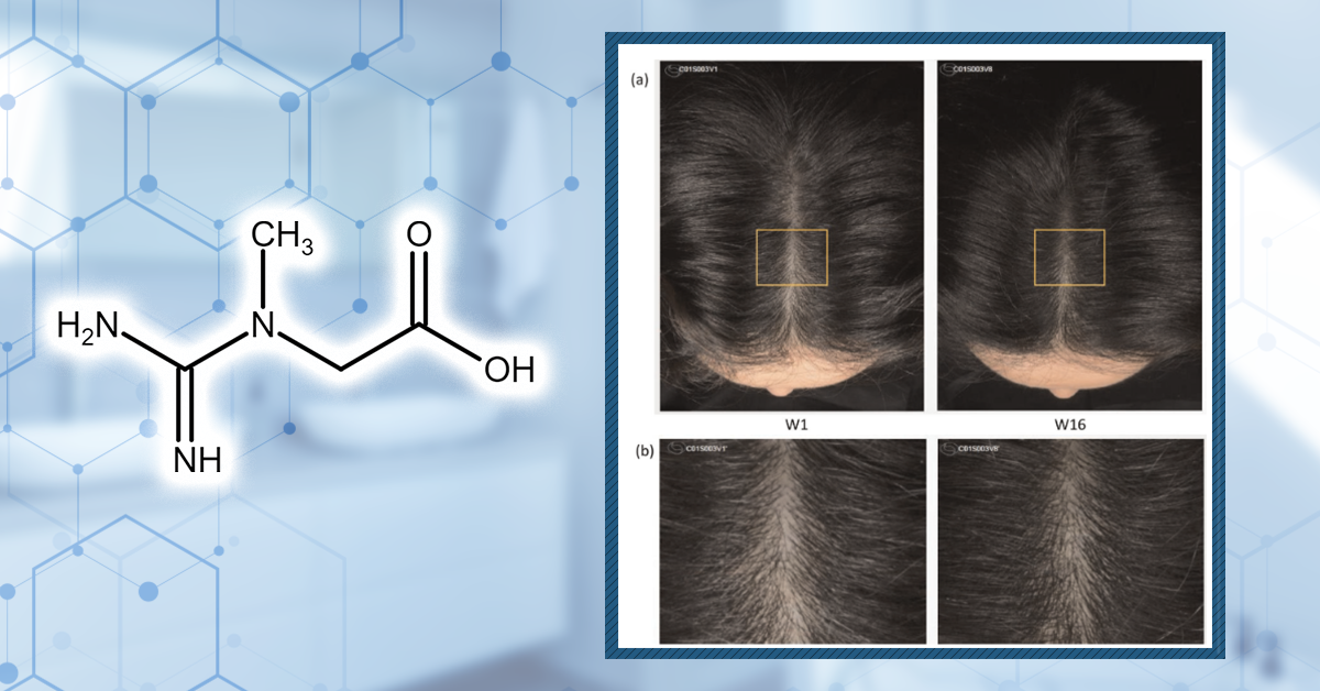 Creatine: Does It Worsen Hair Loss? It Depends On The Hair Loss Type.